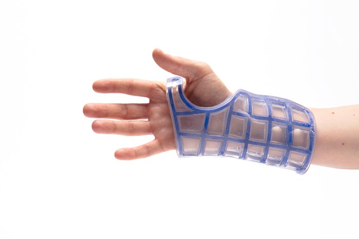 healthcare, innovation, reversible fixation, shape memory, shape memory material, reflex, re:flex, arm cast, design, reshape, reuse, recycle